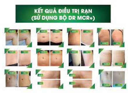 Điều trị Rạn