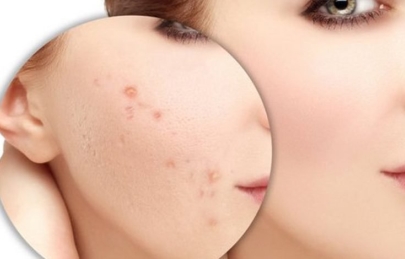 trị thâm mụn tại nhà