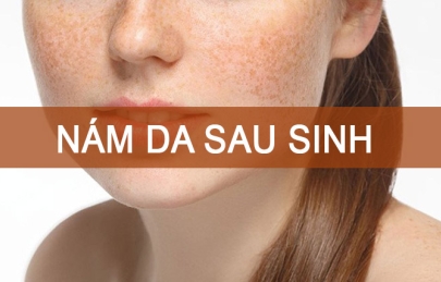 Trị nám sau sinh