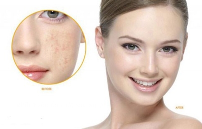 Trị thâm mụn, trị thâm da mặt nhanh nhất hết thâm trong 1 tuần